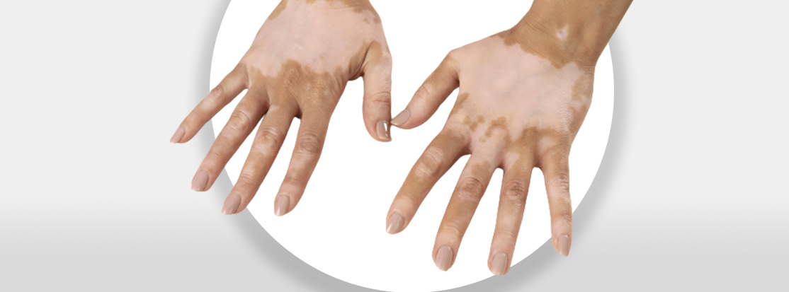 manos con manchas blancas